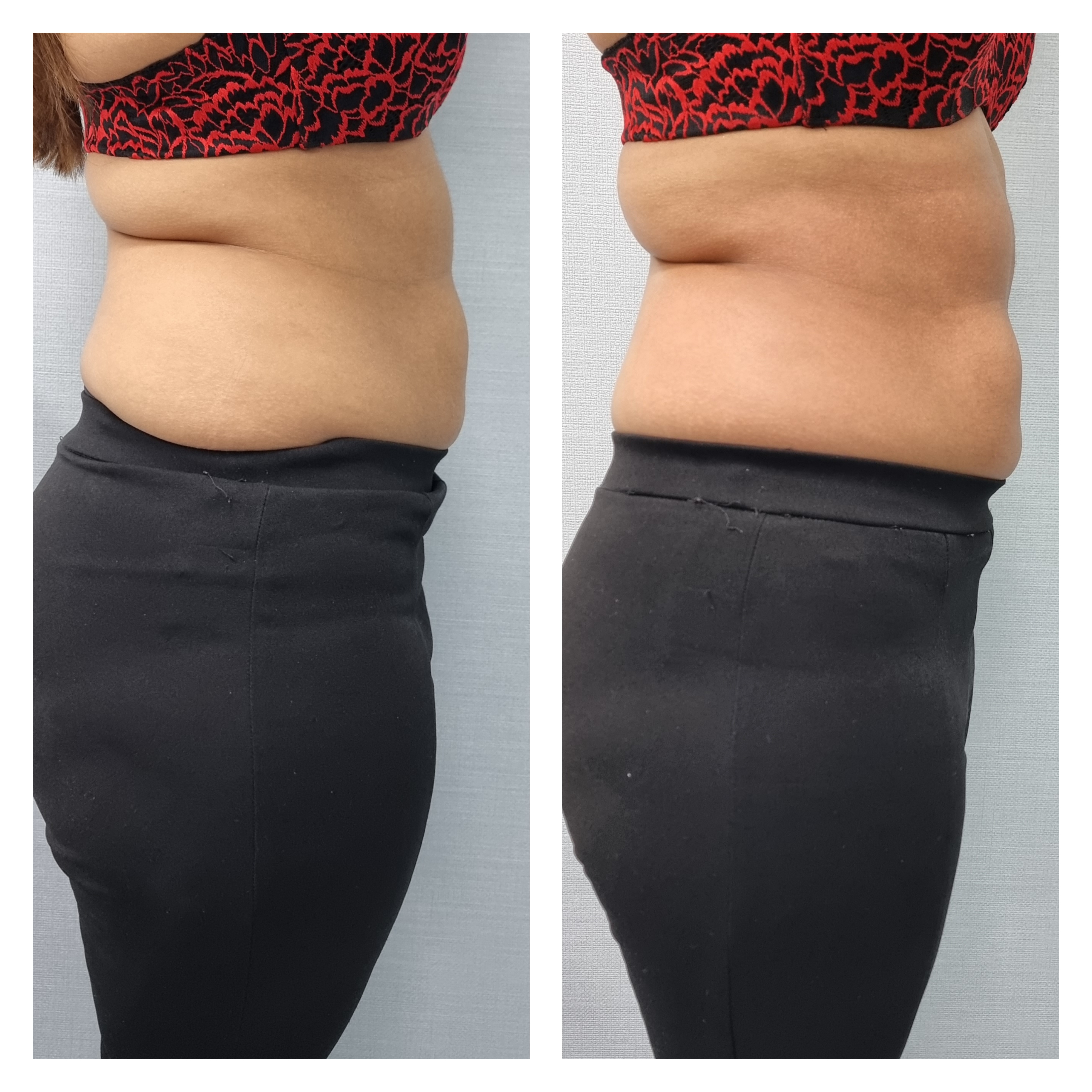 T-Shape 2 result — T shape2 after side