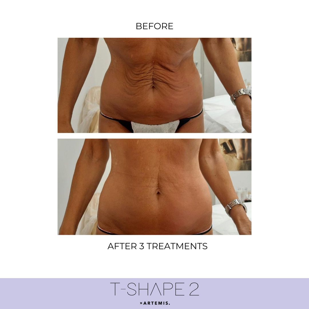 T-Shape 2 result — T2 3 treatments Abdomen