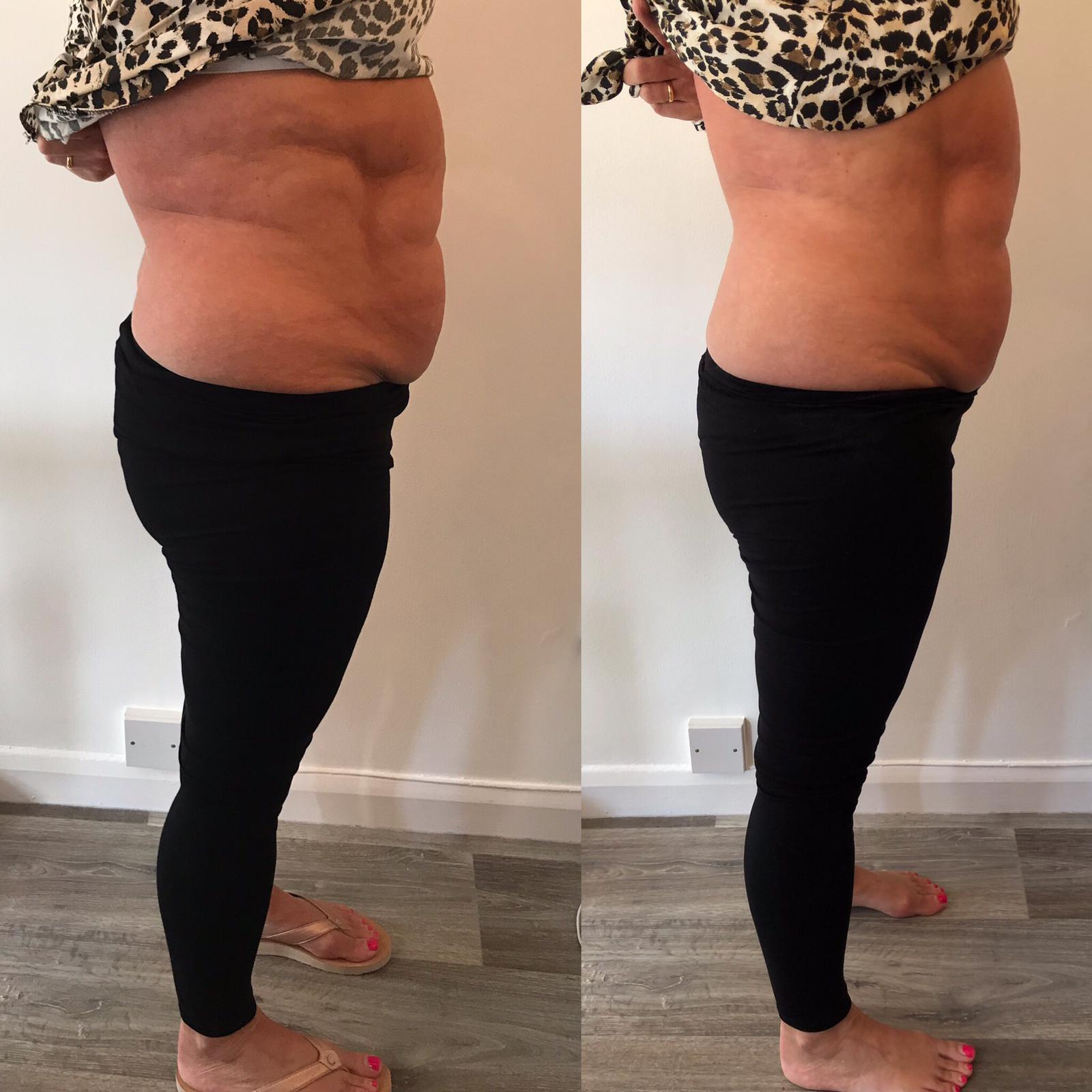 T-Shape 2 result — Tshape after 1 Fibrous fat